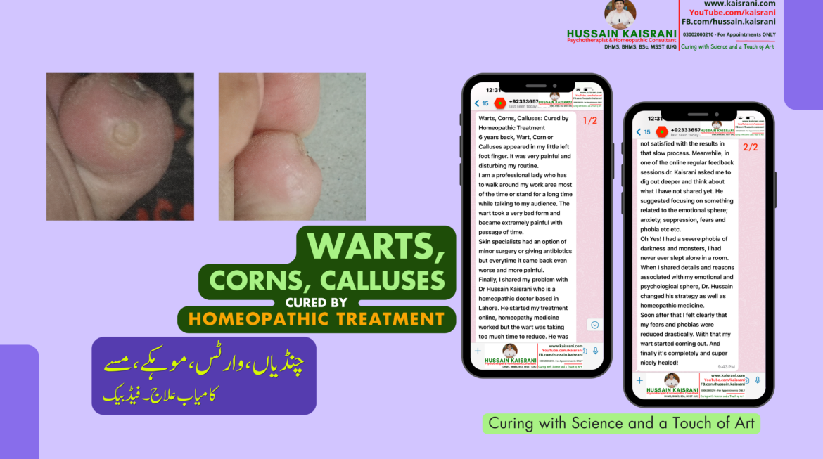 Warts, Corns, Calluses: Cured by Homeopathic Treatment