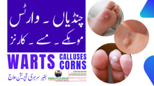 وارٹس مسے موہکے کارنز – کامیاب کیس، ہومیوپیتھک دوا علاج – حسین قیصرانی