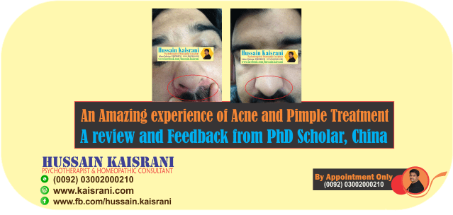 An Amazing experience of Acne and Pimple Treatment by Hussain Kaisrani – A review and Feedback from PhD Scholar, China