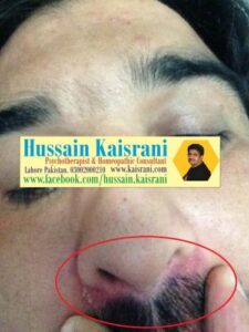 ناک کے ارد گرد پمپل دانے سرخی ۔ کامیاب علاج ۔ فیڈبیک