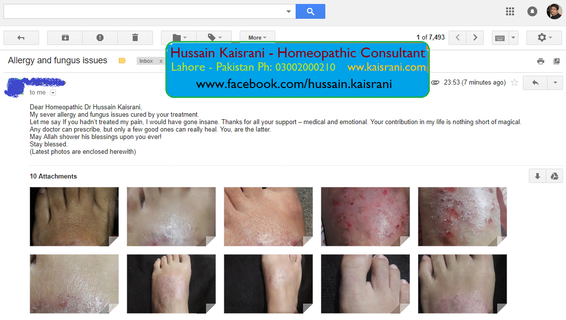 Skin Allergy and fungus issues Cured by Homeopathic Treatment – A feedback from an Online Client