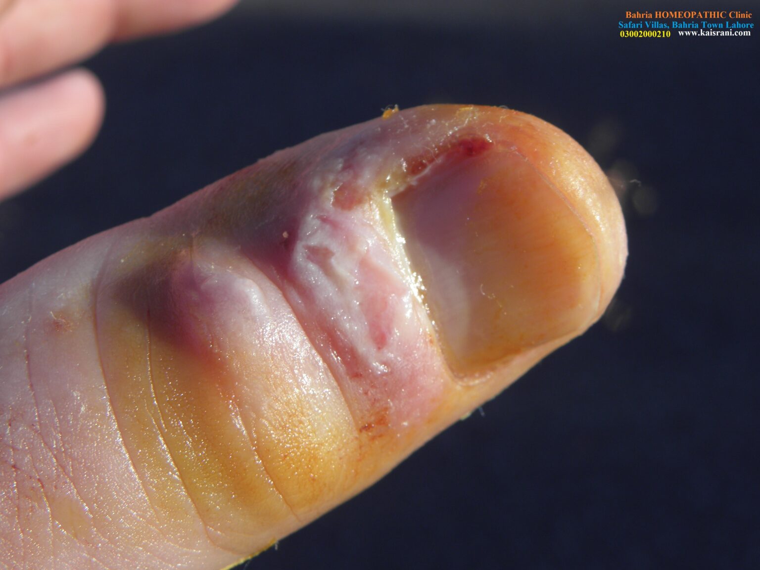 Dr. C. G. Raue discusses Panaritium and presents important remedies with keynotes