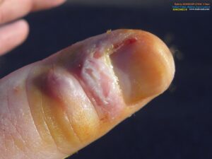 Dr. C. G. Raue discusses Panaritium and presents important remedies with keynotes