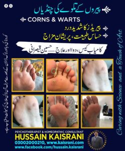 چنڈیاں، وارٹس، موہکے، مسے ۔ کامیاب کیس، دوا اور علاج ۔ حسین قیصرانی