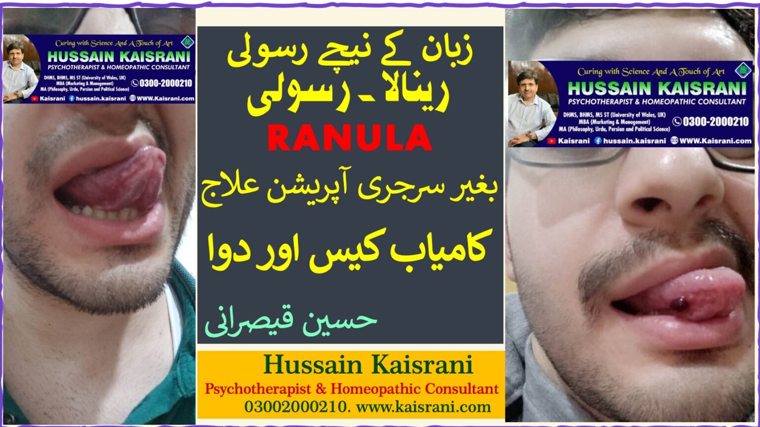 <span class="urdu-title" dir="rtl">رینولا یعنی زبان کے نیچے رسولی ۔۔ بغیر سرجری آپریشن علاج ۔۔ کامیاب کیس، ہومیوپیتھک علاج ۔ حسین قیصرانی</span>
