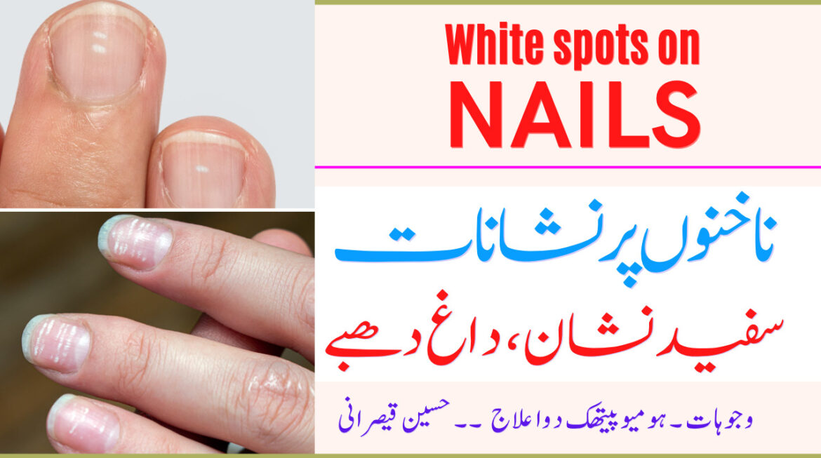 ails Par Sufaid Nishan ka elaaj || Causes White Marks On Nails || Nakhun ke spots ka ilaaj || Urdu Hindi || Hussain Kaisrani