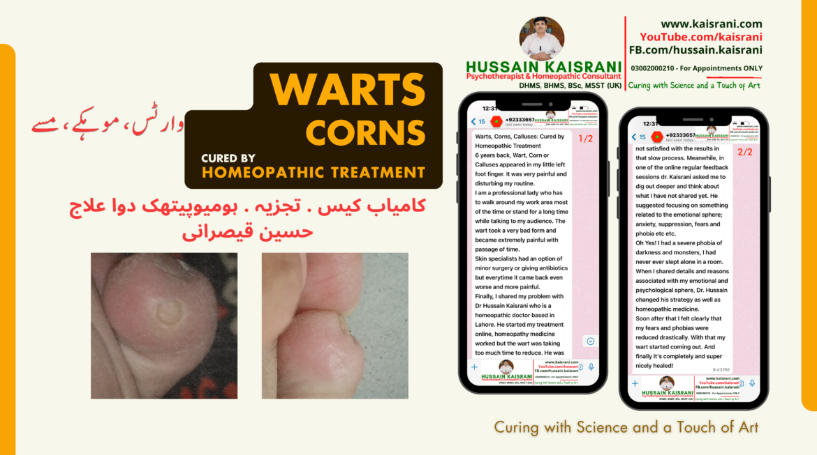 A Solved Case of the Stubborn Warts – Homeopathic Medicine and case analysis – Hussain Kaisrani