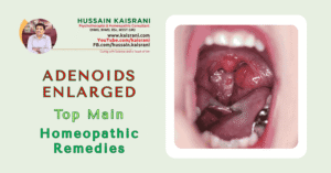 ADENOIDS ENLARGED – Top Main Homeopathic Remedies