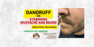 Dandruff on Eyebrows and Beard (Seborrheic Dermatitis): A Key Homeopathic Remedy You Should Know